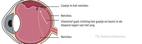 wat is netvliesloslating